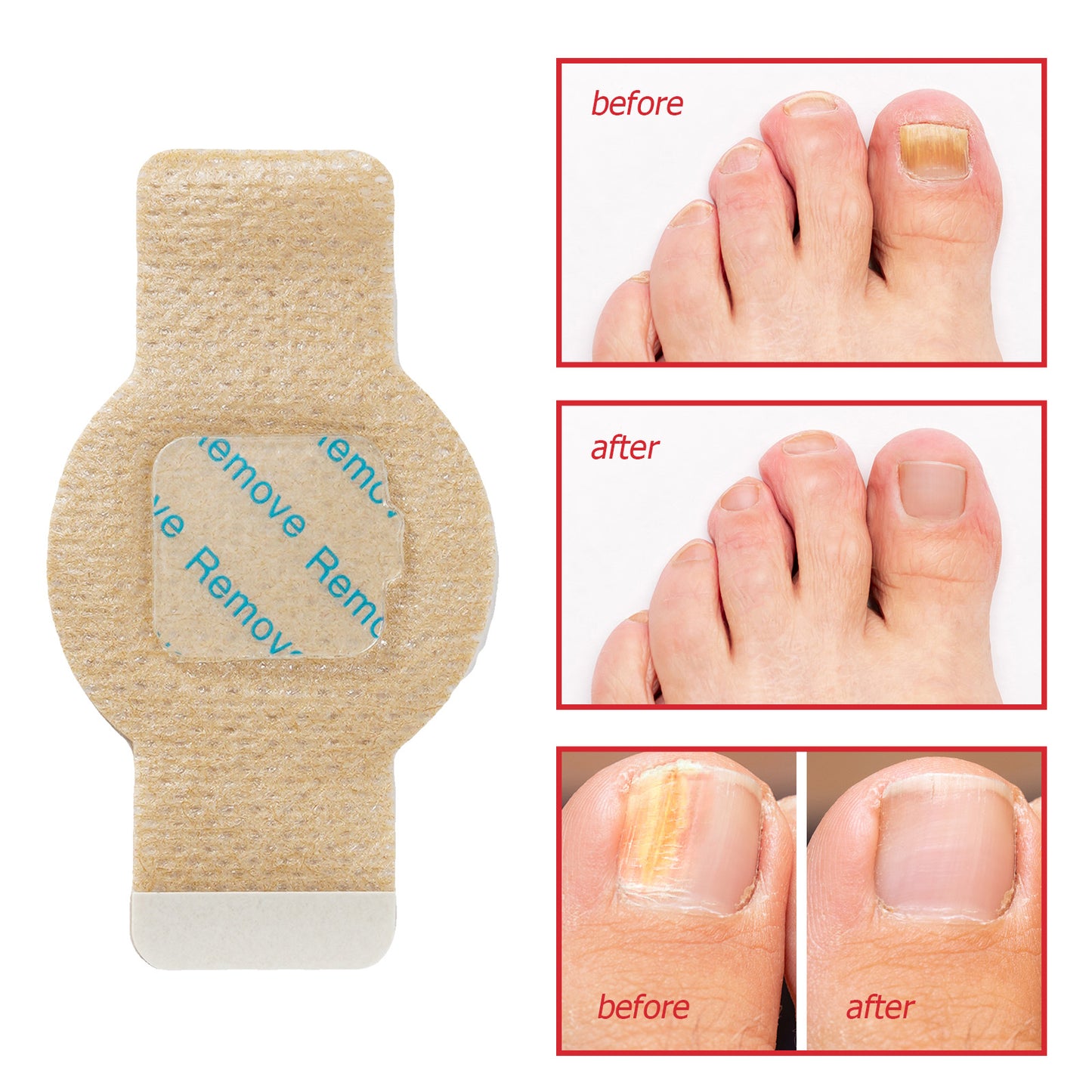 63 Anti Fungal Nail Treatment Patches Toe Fungus Onychomycosis Repair Sticker